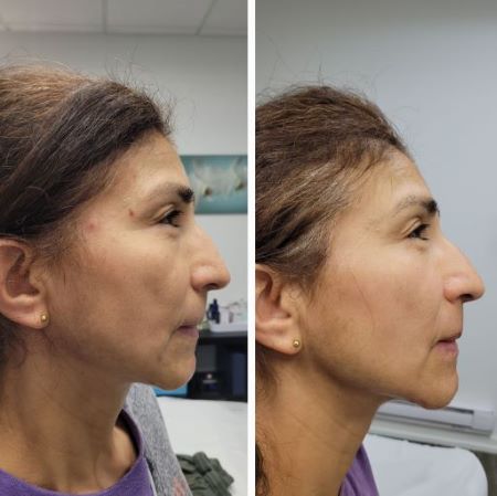 Facial Acupuncture Before and After