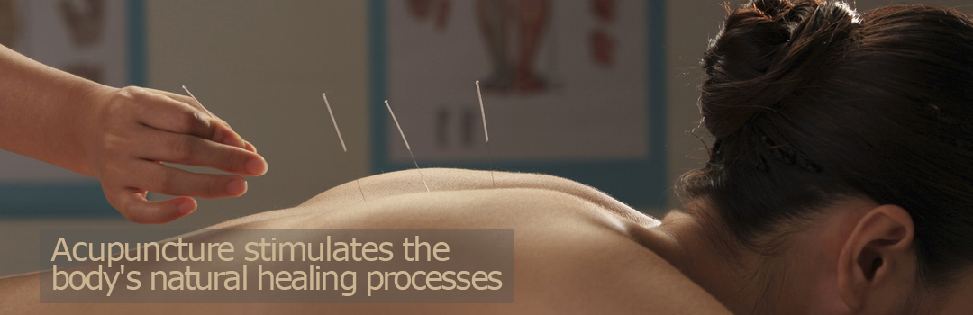Acupuncture stimulates the body's natural healing processes