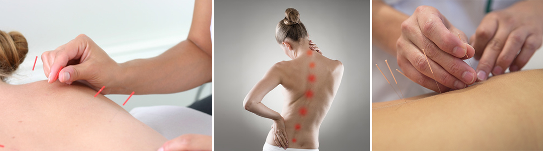Acupuncture for Inflammation