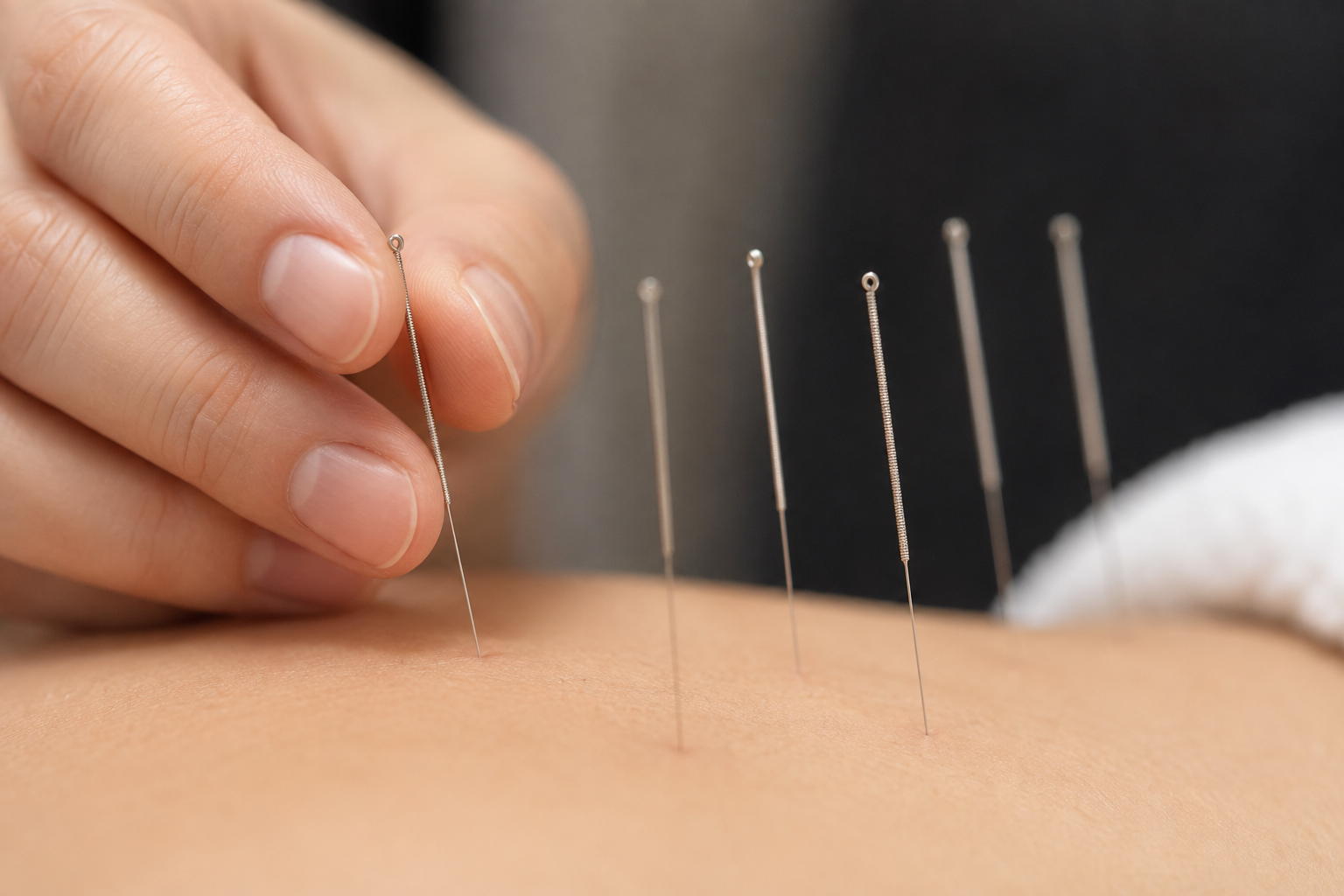 Acupuncture needles