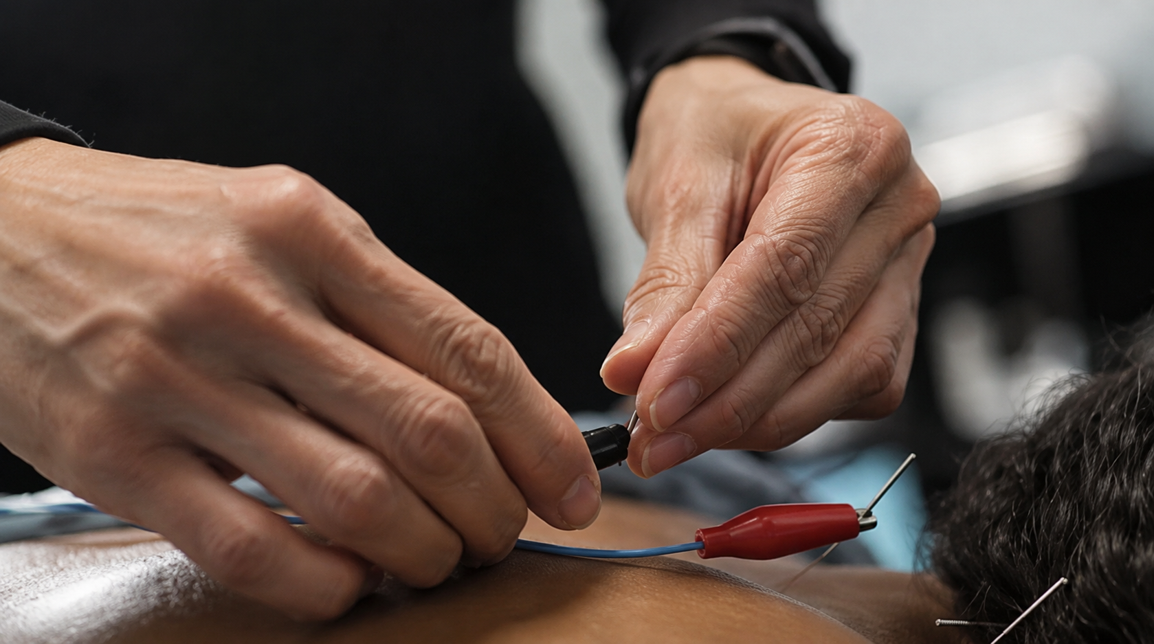 Acupuncture treatment with electrostimulation